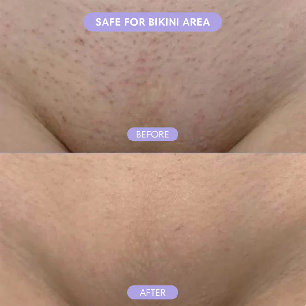 🆙✨2-in-1 Painless Bikini Hair Trimmer for Face & Body