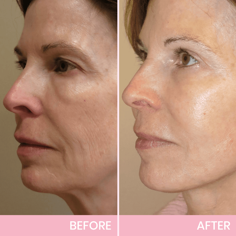 ✨ V-Face Lifting Tape🪄– Instant Jawline Lift & Slim Look