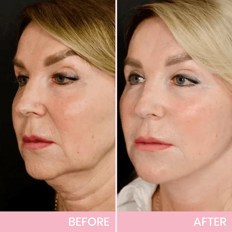✨ V-Face Lifting Tape🪄– Instant Jawline Lift & Slim Look