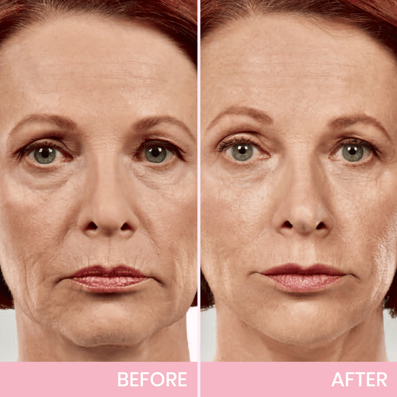 ✨ V-Face Lifting Tape🪄– Instant Jawline Lift & Slim Look