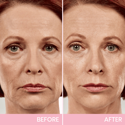 ✨ V-Face Lifting Tape🪄– Instant Jawline Lift & Slim Look
